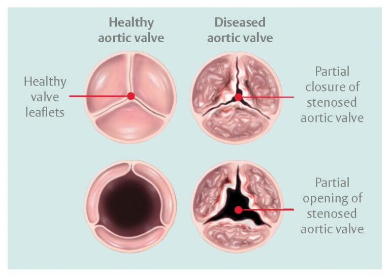 aortic-stenosis-anatomy-diagnosis-treatment-the-valve-clinic