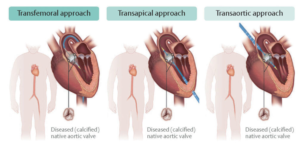 Aortic Stenosis Anatomy Diagnosis Treatment - The Valve Clinic