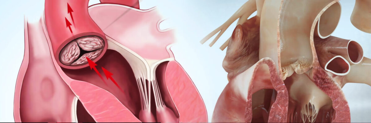 Aortic Stenosis Anatomy Diagnosis Treatment The Valve Clinic